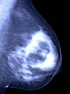 Mammogram