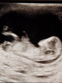 Baby scan, fetus, pregnancy scan, ultrasound scan 