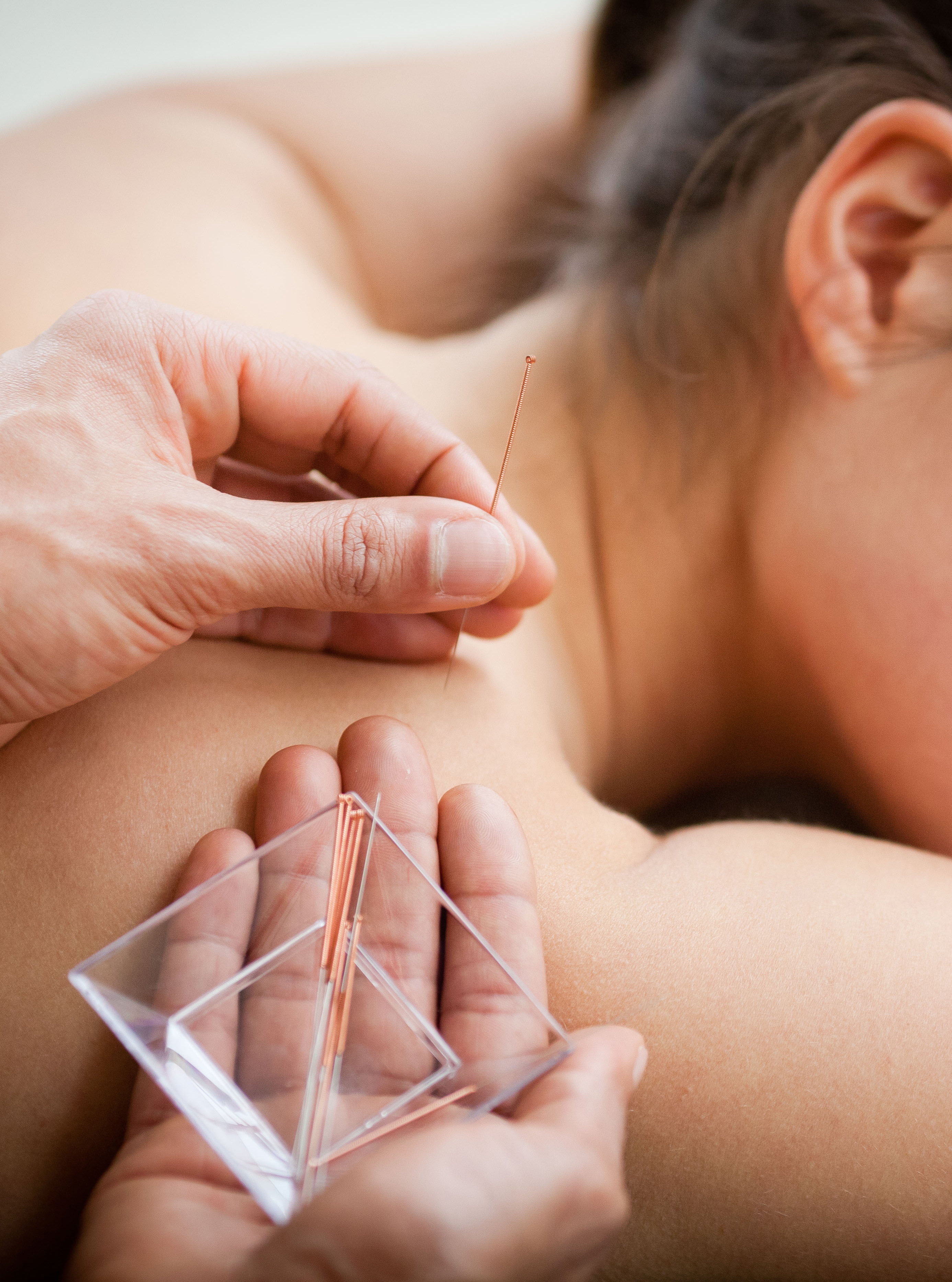 acupuncture lp